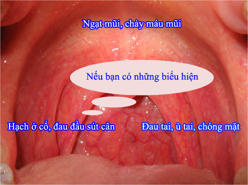 Hình ảnh ung thư vòm họng giai đoạn đầu 9