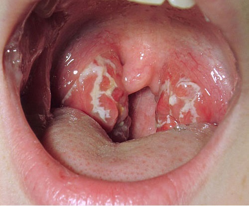Hình ảnh ung thư vòm họng giai đoạn đầu 1