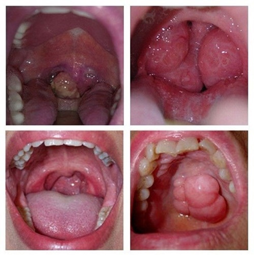 Hình ảnh ung thư vòm họng giai đoạn đầu 10