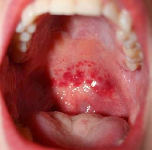 Hình ảnh ung thư vòm họng giai đoạn đầu 11