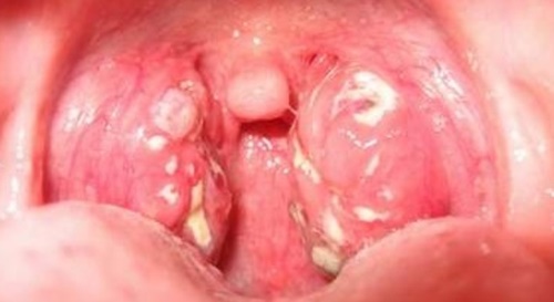 Hình ảnh ung thư vòm họng giai đoạn đầu 12