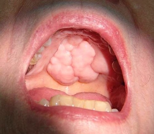 Hình ảnh ung thư vòm họng giai đoạn đầu 13