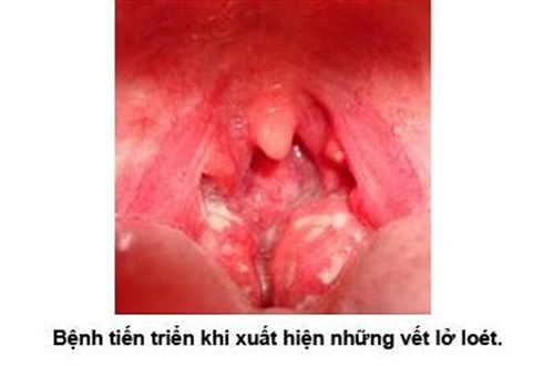 Hình ảnh ung thư vòm họng giai đoạn đầu 14