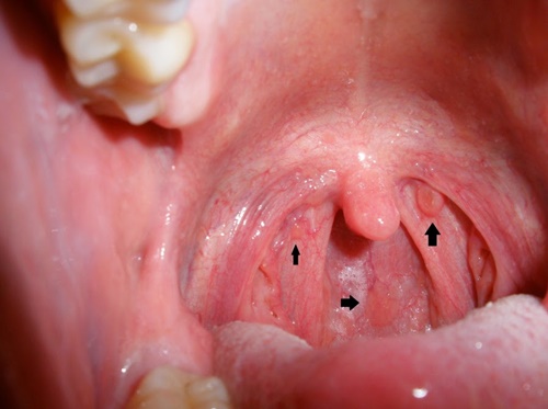 Hình ảnh ung thư vòm họng giai đoạn đầu 2