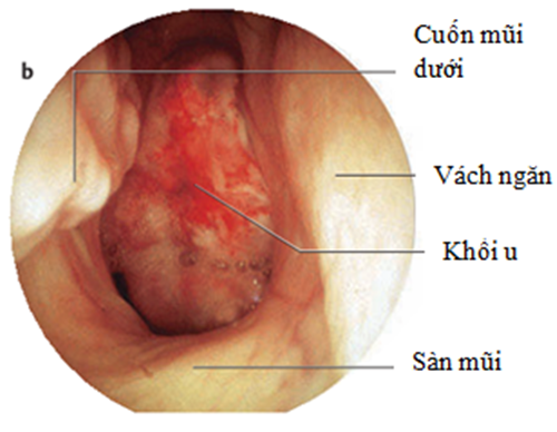 Hình ảnh ung thư vòm họng giai đoạn đầu 3