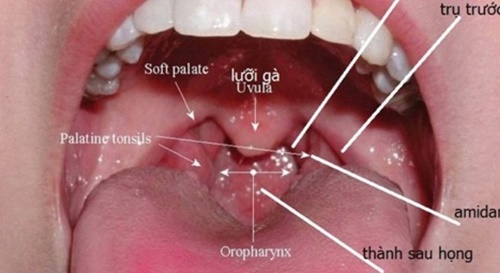 Hình ảnh ung thư vòm họng giai đoạn đầu 4