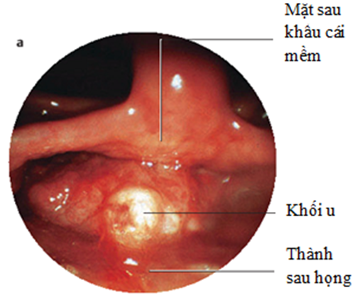 Hình ảnh ung thư vòm họng giai đoạn đầu 5