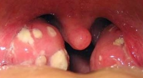 Hình ảnh ung thư vòm họng giai đoạn đầu 7